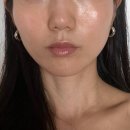 KD타워 | 비본영의원 쿨소닉 리프팅 내돈내산 솔직 후기 (라인 변화 확실)