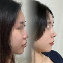강남역 /신논현역 성형외과 코수술 후기 2주차 변화 과정