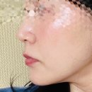 대구 동성로 피부과 온다리프팅 전후 비교 총평 후기