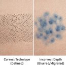 모텐셜의원 | 삭발 두피문신 부작용? '이것' 모르면 곰팡이처럼 번집니다