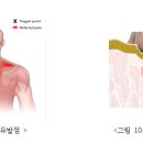 📌 통증유발점(Trigger Point)과 연관통(Referral Pain) 이미지