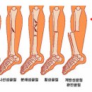 골절[fracture]질환이란? 이미지