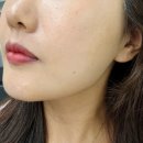 압구정로데오피부과 리투오 5cc 통증? 효과 본 후기