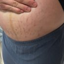 예지인피부과의원 | [임산부로 살아가기 6탄] 37주차 솔직후기 | #내진검사 #자궁문안열림 #튼살(사진주의) #출산휴가 #출산...