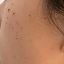 성지한의원 | 대구편평사마귀, 쥐젖제거무제한 성지 한의원 제거 후기 (ft.대만족)