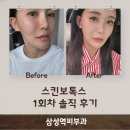 삼성역피부과 스킨보톡스 1회차 솔직 후기 , 민낮 자신감 생긴이유!