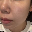 주식회사 강동수면센터 | [강동구피부과] 울쎄라 300샷 효과 통증 전후 후기 대만족 후기