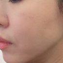 아름다움의원 | 강남 볼필러 리쥬비엘 필러 후기 – 아름다움을 다시 빚는 도자기의원