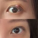 눈다래끼 콩다래끼 수술 후기 / 버티면 망한다 자연치유 같은 소리하네