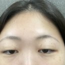 구로 끗한의원 | 구로 끗한의원 ) 내돈내산 주근깨뺀 후기💋