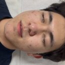 박달우성아파트(컴팩트) | 레나제이 에스테틱 안양 여드름 관리 바이오리필 피부과 솔직 후기 추천 청소년 여드름