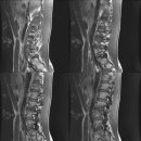 허리 MRI 판독결과인데 도와주세요ㅠㅠ 이미지