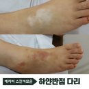 서울 하얀반점 다리 피부색복원 1차커버 후기