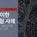 특이한 암보험 사례: 소액암이 일반암으로 바뀌는 경우 이미지