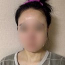 2호선 센텀시티역 | 부산 경성대 근처 피부과, 포텐자 펌핑팁+안아픈 리쥬란 내돈내산 후기