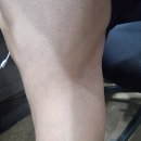 참하지외과의원 | 하지정맥류 수술 참하지외과(내돈내산 진료 후기)