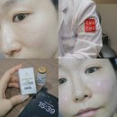 200 | 부산 울트라콜 잘하는곳 추천 : 해운대 피부과 울트라콜 200 내돈내산 후기