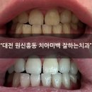 새이처럼치과의원 | [대전 치아미백 진짜 잘하는 치과 강추] 내돈내산 "원신흥동 치과 치아미백 3회 후기"