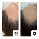 미로헤어라인 | [시흥 능곡동 헤어라인 문신 후기] 미작뷰티 시흥점에서 엄마 헤어라인 자연하게 채워드린 기록✨