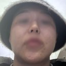 청담디어의원 | [공지] 온다 리프팅 내돈내산 후기!!! (상태 지속적 업뎃 예정)
