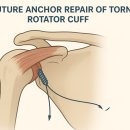 기린한의원 | 회전근개 파열 수술해야하나요? <대구 기린목한의원>