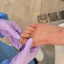라파엘뷰티케어 | 이천 문제성 발 전문 라파엘 내성발톱 졸업?