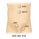 재발성 탈장(Recurrent hernia) 이미지