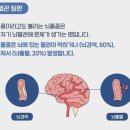 겨울이면 부쩍 늘어나는 뇌졸중…추위 보다 ‘이것’ 영향이 크다는데 이미지