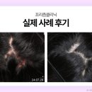 신도림초등학교 | 신도림탈모병원｜지루성 두피인데 탈모치료 받아도 될까? 순서가 중요합니다