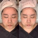광주 홍조 피부관리 / 글리나뷰티에서 물방울관리 후기