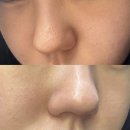 3 | 내돈내산 |포텐자 모공 레이저 3회 후기 |전후비교 솔직 정리