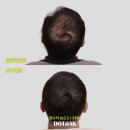 글로웰의원 | 정수리두피문신 후기, 직접 경험한 놀라운 변화