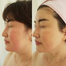 청담뷰티 카넬라’ 황민영 대표원장님 물방울리프팅&amp;모공디톡스 3만 원 감동 후기! (주차 팁) 내돈내산
