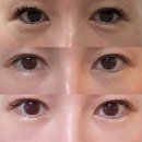 꿈꾸는성형외과의원 | 지방재배치, 미루면 하안검 수술까지? 지금이 눈밑 안티에이징 골든타임입니다 | 강남역 꿈꾸는성형외과