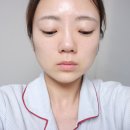 청담피부과에서 받은 티타늄리프팅플러스 리얼후기