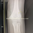 8세 어린이 골절 및 오픈캐스트 깁스 치료 후기