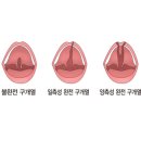 구개열 (Cleft palate) 성형미용, 소아 청소년 질환이란? 이미지