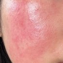 고혈압 | 고혈압약 종류 효과 부작용 고혈압 관리 방법 후기