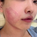 핑크멍 | 구월동피부과 추천 인모드FX 윤곽주사 내돈내산 멍 통증 후기