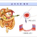 위, 십이지장 궤양 이미지