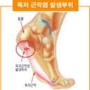 [발뒤꿈치 통증 증후군] 족저근막염 증상, 원인 및 치료 이미지