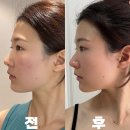 압구정역피부과 볼링크 시술 후기 및 변화 (슈링크유니버스 볼뉴머 300샷)