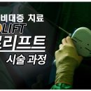 15분만에 끝나는 유로리프트 실제 시술 과정 영상 이미지