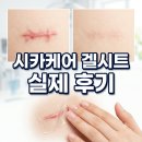 사카 | 사카케어 겔시트 후기, 실제 사용해본 효과와 단점 총정리