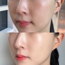샤인 | 논현역 피부과 딜라이트하게 리쥬란 더마샤인 후기내돈내산