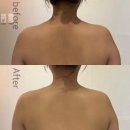 리랩 | 대전승모근관리 원신흥동 리랩 신부관리 승모근내리기 후기