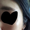 트랜스 | 수원여드름흉터 새살침 트랜스테라피,내돈내산 후기