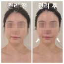 성환역 | 천안에스테틱 추천｜1회 만에 달라진 윤곽! 성환역 스파애 Re:페이스 윤곽관리 후기