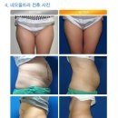 네오성형외과의원 네이버블로그