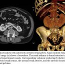 8 Horseshoe kidney with anteriorly oriented renal pelvis 이미지